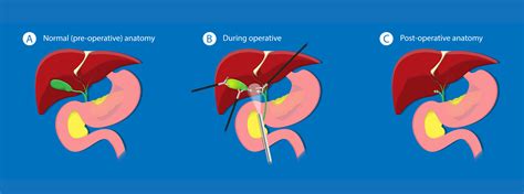 Cholecystectomy — Hepatobiliary And Upper Gastrointestinal Surgery