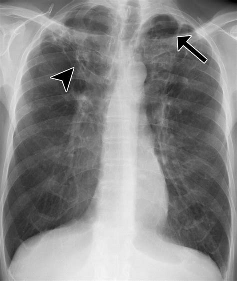 Pulmonary Tuberculosis Role Of Radiology In Diagnosis And Management