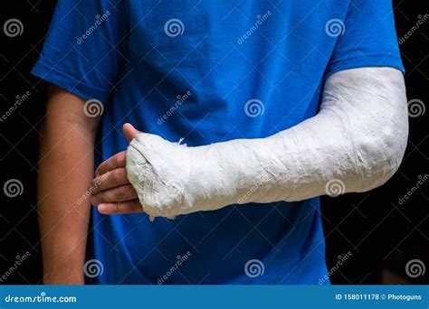 Man With Broken Arm Wrapped Medical Cast Plaster Fiberglass Cast