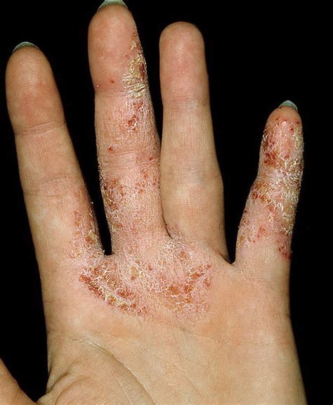 Eczema Between Fingers Pictures 105 Photos And Images