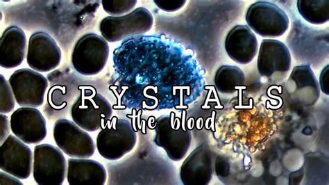Crystals In Blood Blood Under A Microscope Microscopy Youtube