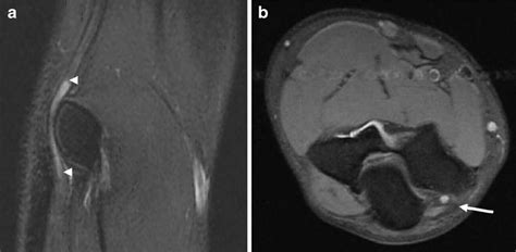 Mri Of The Elbow A T2w1 Sagittal View There Is Thickening And