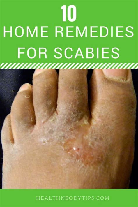 How To Get Rid Of Scabies Top 10 Home Remedies For Scabies