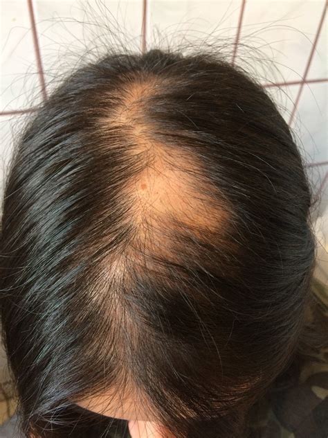 Celiac Disease Hair Thinning No Pattern Hair Loss Hair Transplant