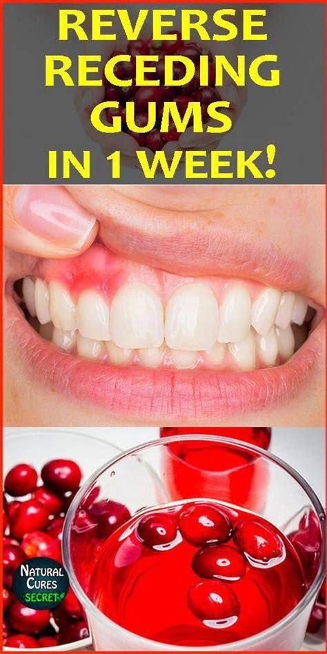 Grow Back Your Receding Gums Naturally In 1 Week Home Remedies Are