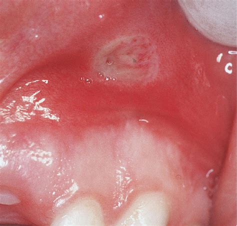 Recurrent Oral Ulceration Aphthous Like Ulcers In Periodic Syndromes Sexiz Pix