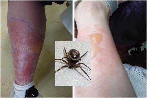 What Does A False Widow Spider Bite Look Like Reaction To False Widow Spider Bite Stock Image