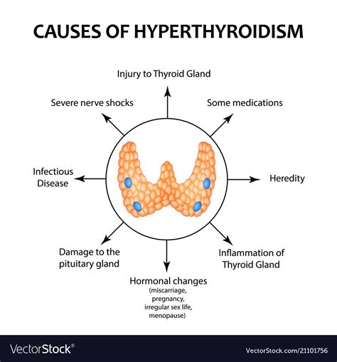 Causes Hyperthyroidism Thyroid Gland Royalty Free Vector