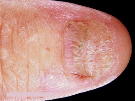 Others suspect that the condition may be an autoimmune disorder, but more studies have to be done. Lichen Planus - Causes, What It Looks Like & How to Get ...