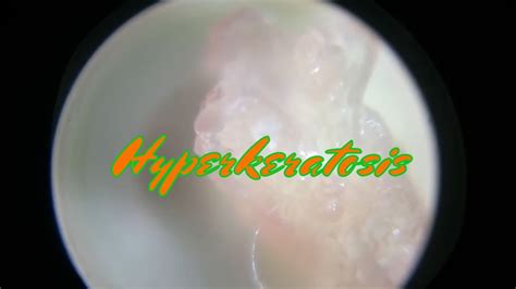 Morgellons Crystal With Fiber Youtube
