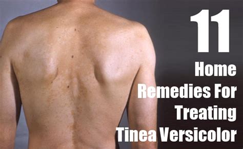 11 Effective Home Remedies For Treating Tinea Versicolor Morpheme