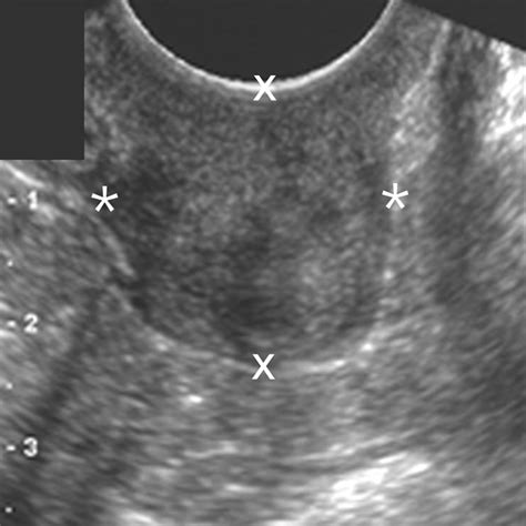 Gray Scale And Color Doppler Sonographic Features Of The Vaginal Cuff And Cervical Remnant After