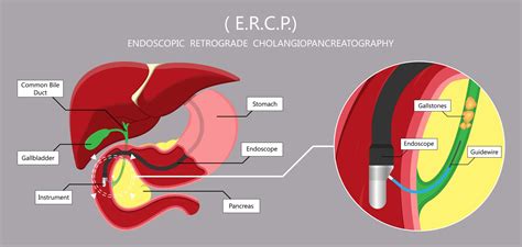Ercp In Singapore Alpha Digestive And Liver Centre