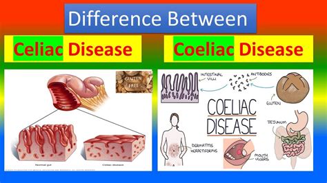 Difference Between Celiac Disease And Coeliac Disease Youtube