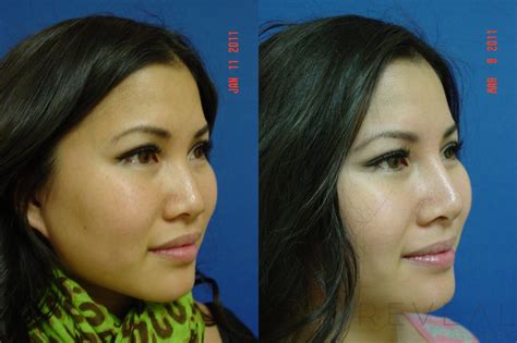 Asian Rhinoplasty Before And After Pictures Case San Jose Ca Reveal Plastic Surgery