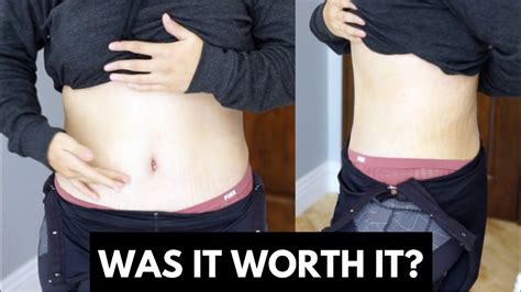 Hernia Photos Before And After Tummy Tuck Peryhost