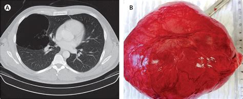Bulla In The Lung The Lancet