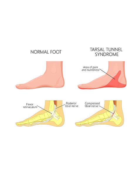 Tarsal Tunnel Syndrome Test Treatment Boston Foot Ankle Biologics