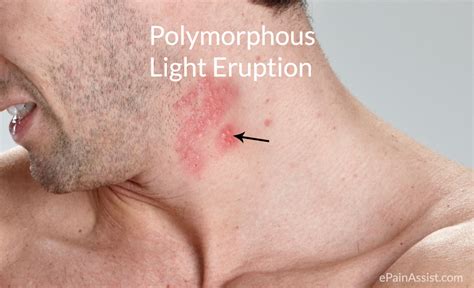 What Helps Polymorphic Light Eruption