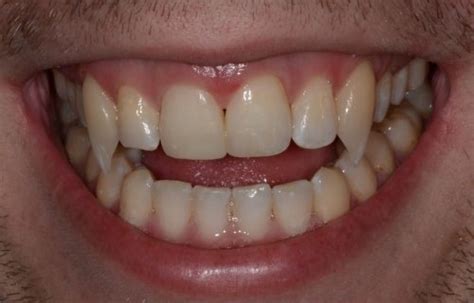 Vampire Teeth For Halloween Naperville Cosmetic Dentist
