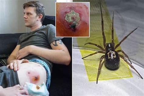 The Worst Spider Bite Pictures Including The Brown Re