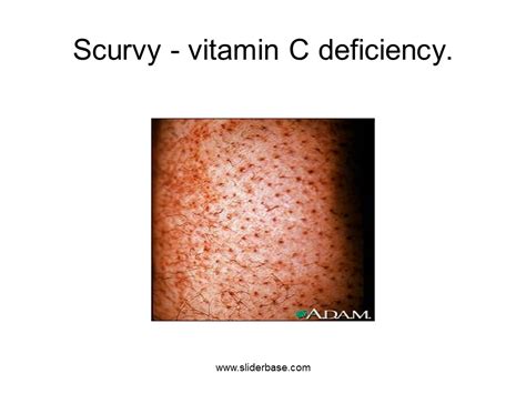 How Scurvy Disease Affect Human