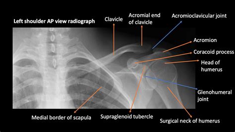 Scapula Fracture X Ray My XXX Hot Girl