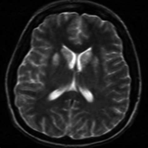 Ct Head 5 D Postanoxic Brain Injury With Low Attenuation In Bilateral