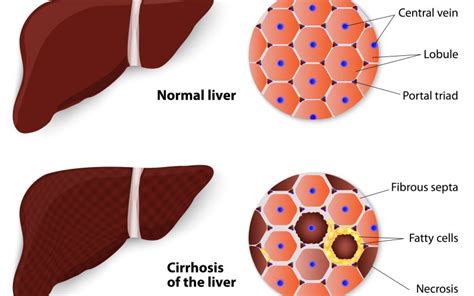 Chronic Liver Disease Signs And Symptoms Gastroenterologist Tips To