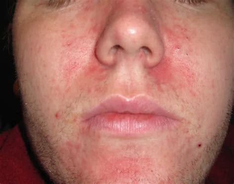 Red Rash On Nose Dorothee Padraig South West Skin Health