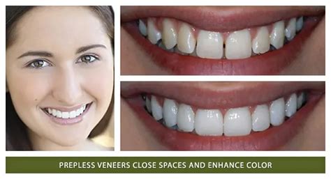 Cosmetic Dentistry Before And After Dentist Lafayette Boulder