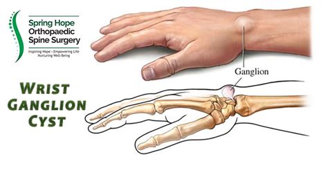 Wrist Ganglion Orthopaedic Spine Surgery Singapore