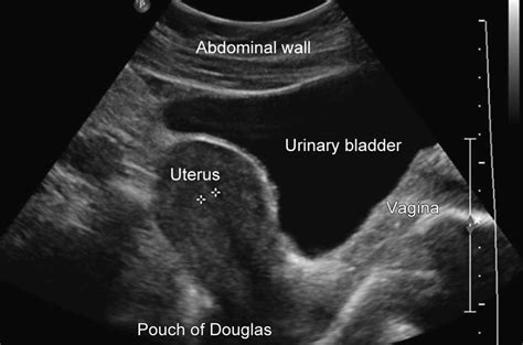 Bladder Uterus Anatomy