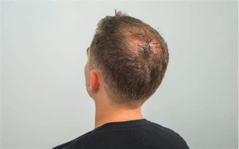 30 Haircuts For Balding Crown To Fix Bald Spots Fast Arnoticiastv