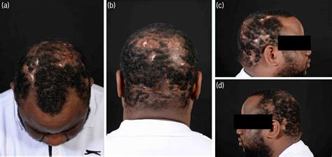Severe Dissecting Scalp Cellulitis Successfully Treated With Serial