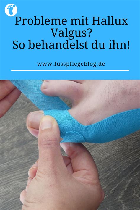 Pin Auf Hallux Valgus