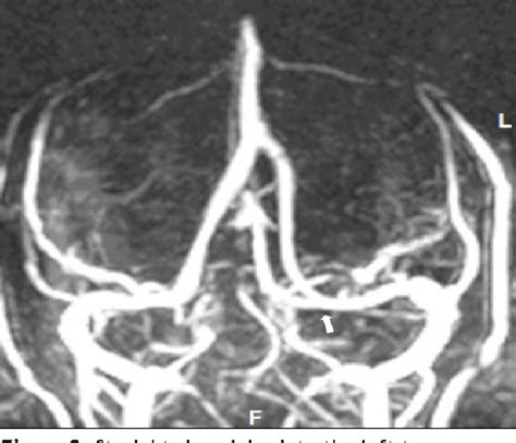 Figure From Superior Sagittal Sinus Bifurcation Variation Semantic