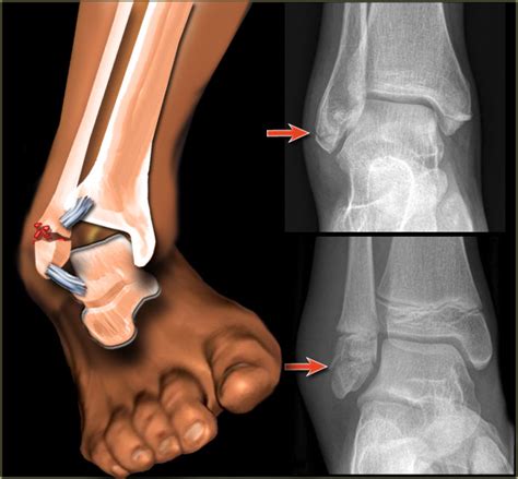 Fractured Ankle Broken Ankle Symptoms And Treatment