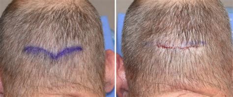 Occipital Knob Nuchal Ridge Reduction Incision Dr Barry Eppley