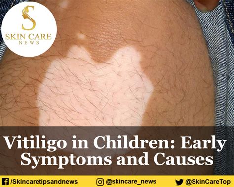 Vitiligo In Children Early Symptoms And Causes