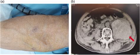 Findings In Case 1 A An Eschar On The Patients Forearm And B