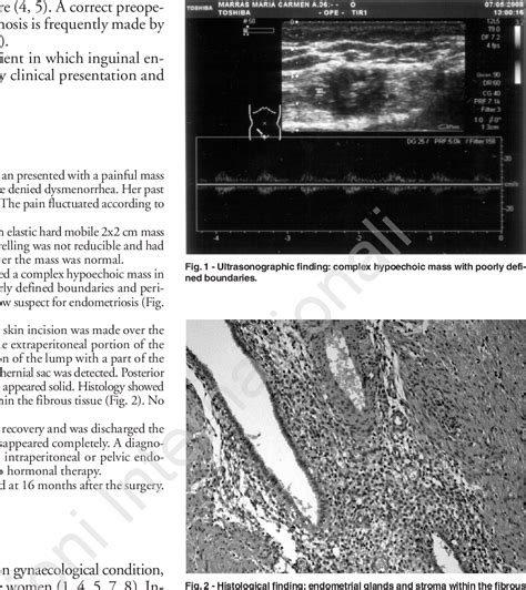 Figure 2 From Isolated Inguinal Endometriosis Case Report With
