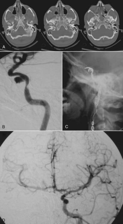 Blunt Cerebrovascular Injury Neupsy Key