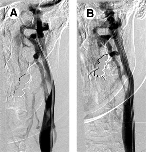 Catheter Venography And Endovascular Treatment Of Chronic Cerebrospinal