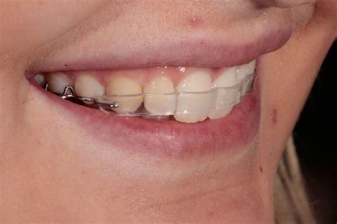 Minimally Invasive Natural Smile Makeover Delights Patient Uk