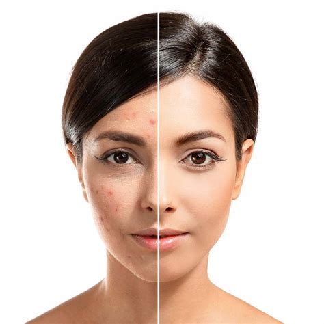 Ipl Photofacial Skin Med Spa And Laser Texas