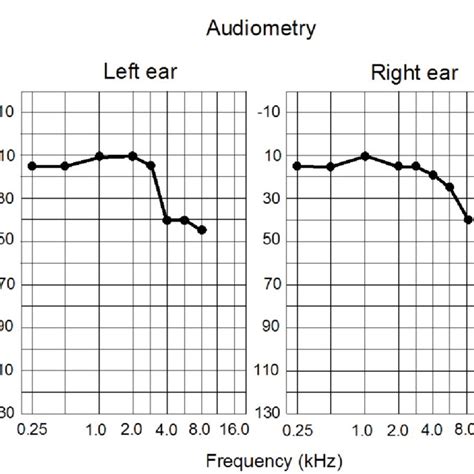 Audiometric Data Are Shown For The Left And Right Ears Sound Intensity