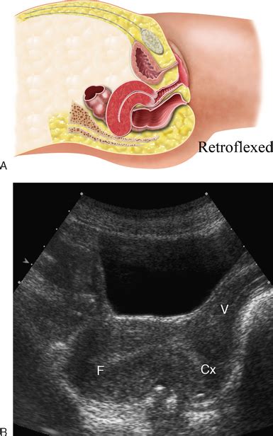 Intermittent myometrial contractions and changes in uterine shape and position are normal during pregnancy. ULTRASOUND EVALUATION OF THE UTERUS | Radiology Key