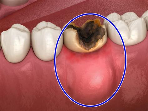 Understanding Dental Abscess Causes Treatments And Risks