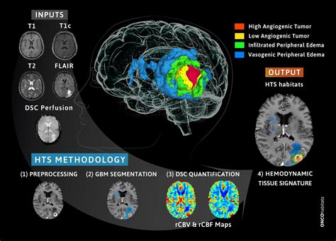 New Methodology Developed To Monitor Patients With Glioblastoma